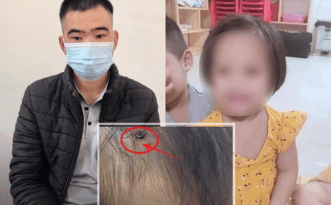 bé gái nghi bị cha dượng cắm đinh lên đầu